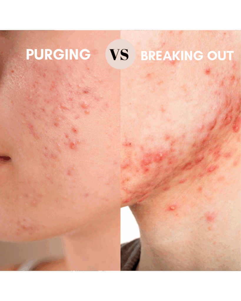 Difference between the skin detoxification and breaking out due to an irritation.