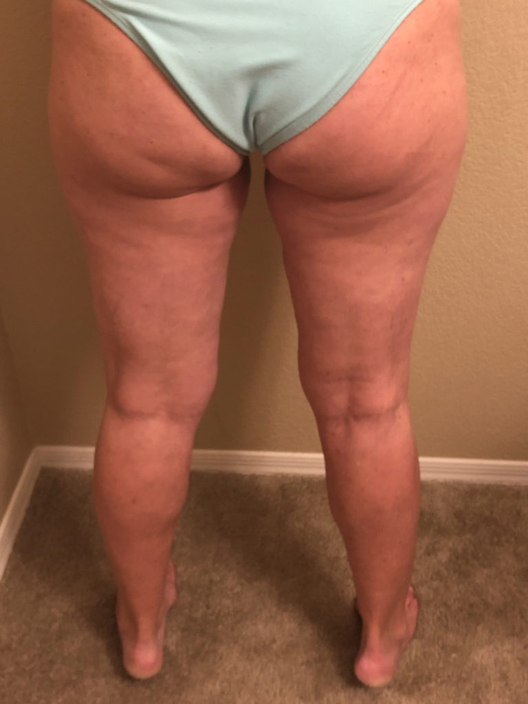 Rebecka Read before and after using Seaweed Body Gel for 30 days.