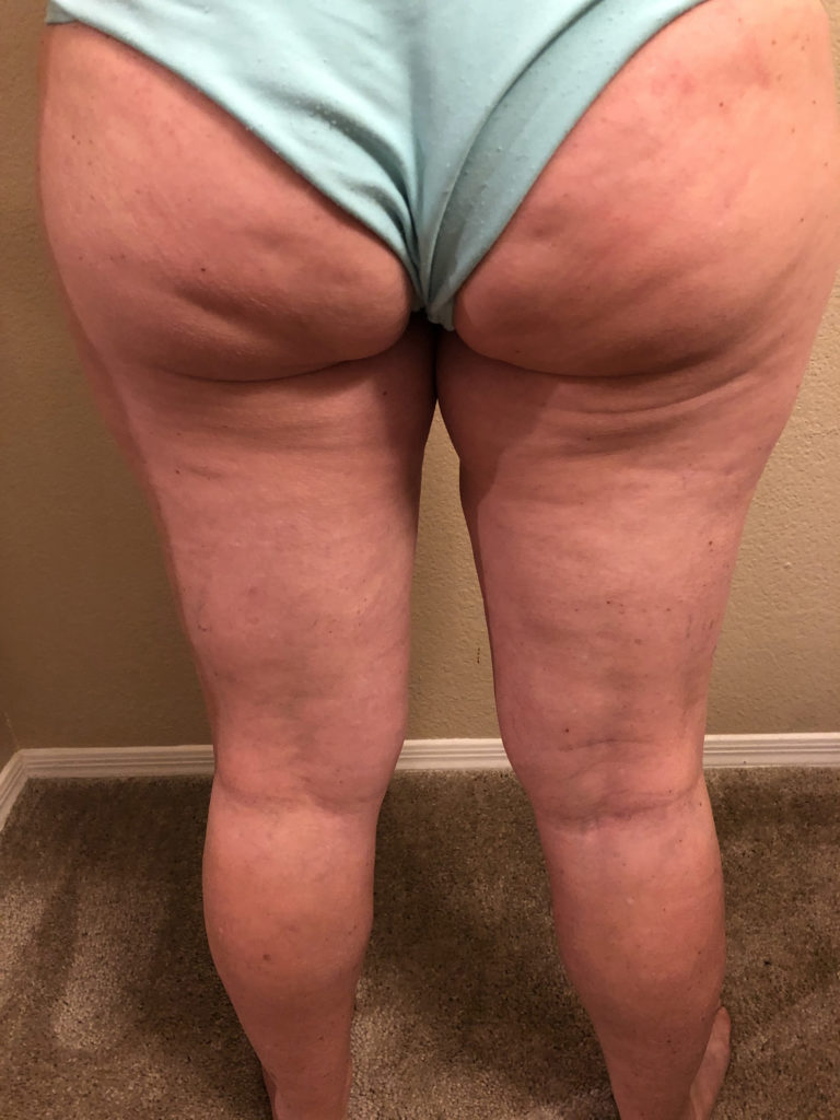 Before and after using Seaweed Body Gel for 30 days, the cellulite is almost gone.