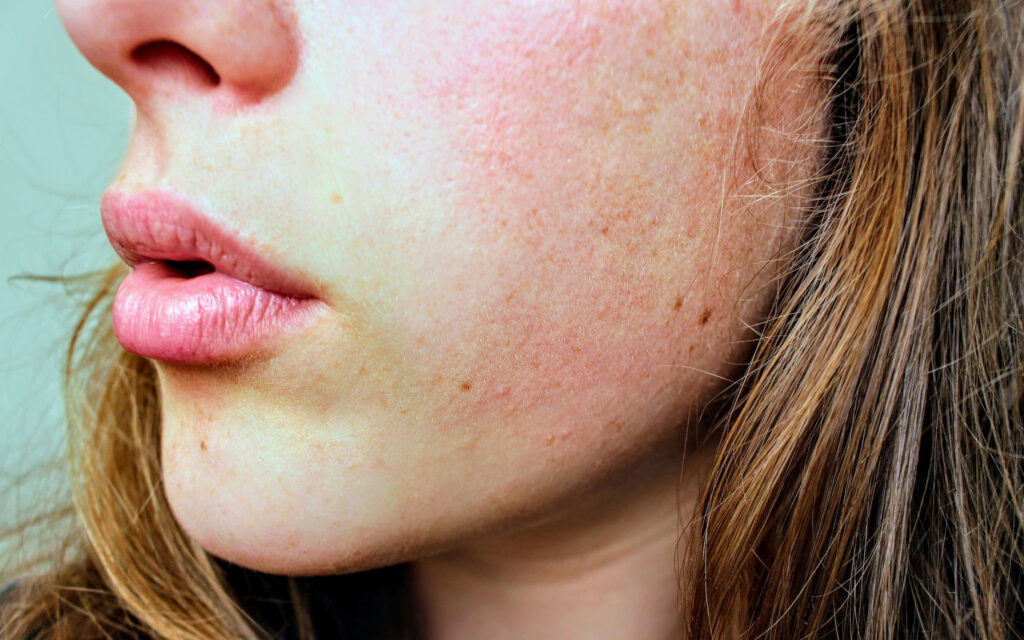 irritated skin showing redness