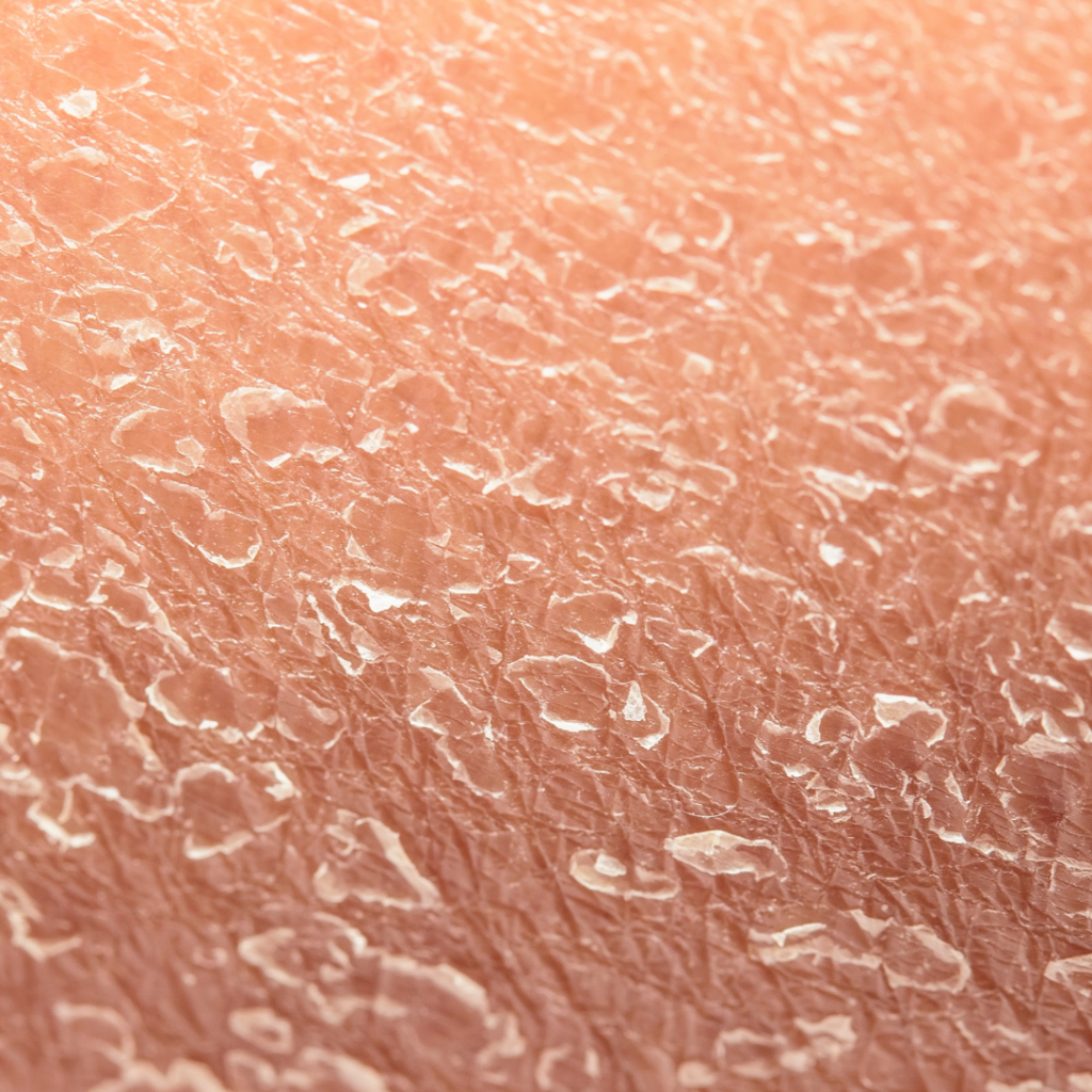 17 - Seaflora Skincare Why retinol causes flakey skin