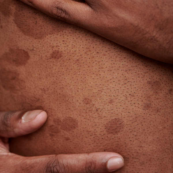 Uneven skin tone - Seaflora Skincare is it hyperpigmentation or a fungal infection?