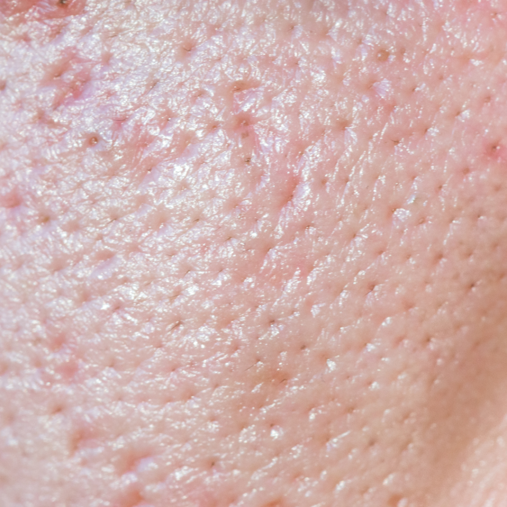Deep pores and blackheads