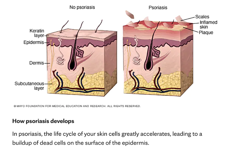 healthy skin vs. psoriasis