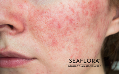 "A woman's face with visible redness and irritation symbolizing hormonal acne, with Seaflora Skincare logo included.