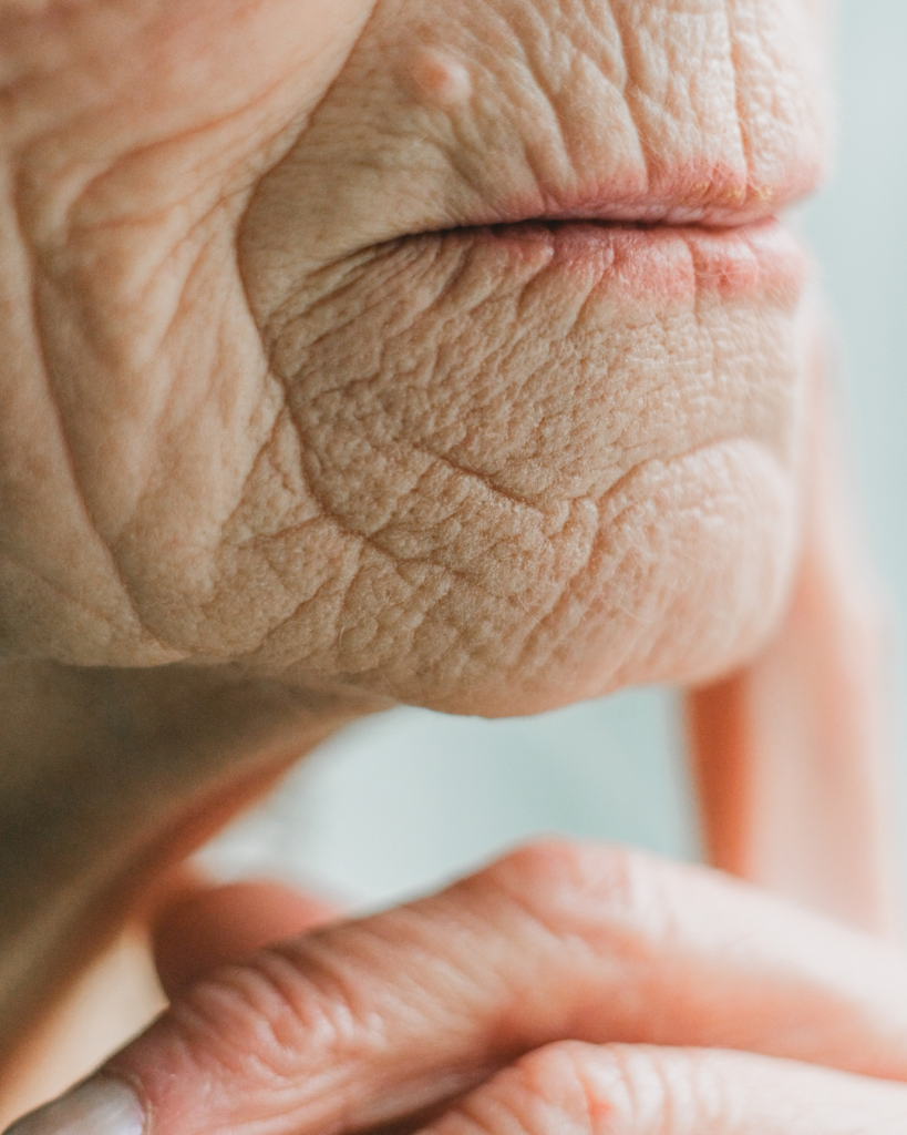Wrinkled skin from a lack of Collagen.