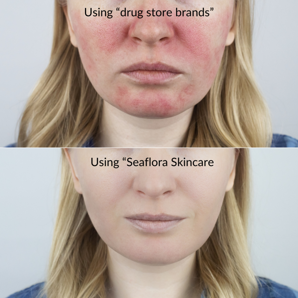 Rosacea-before-and-after-Seaflora-Skincare-for-30-days - Seaflora Skincare skincare for eczema
