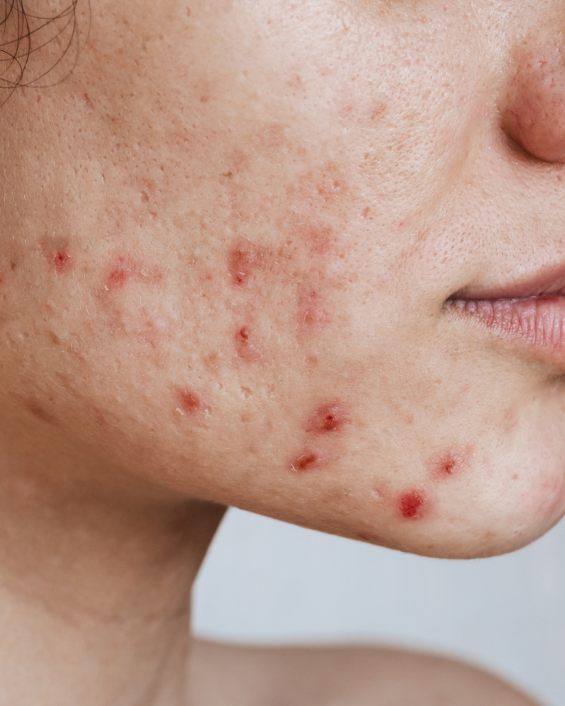 Hormonal Acne: Understanding Its Common Patterns - Seaflora Skincare A lady with hormonal acne due to a hormones imbalance.