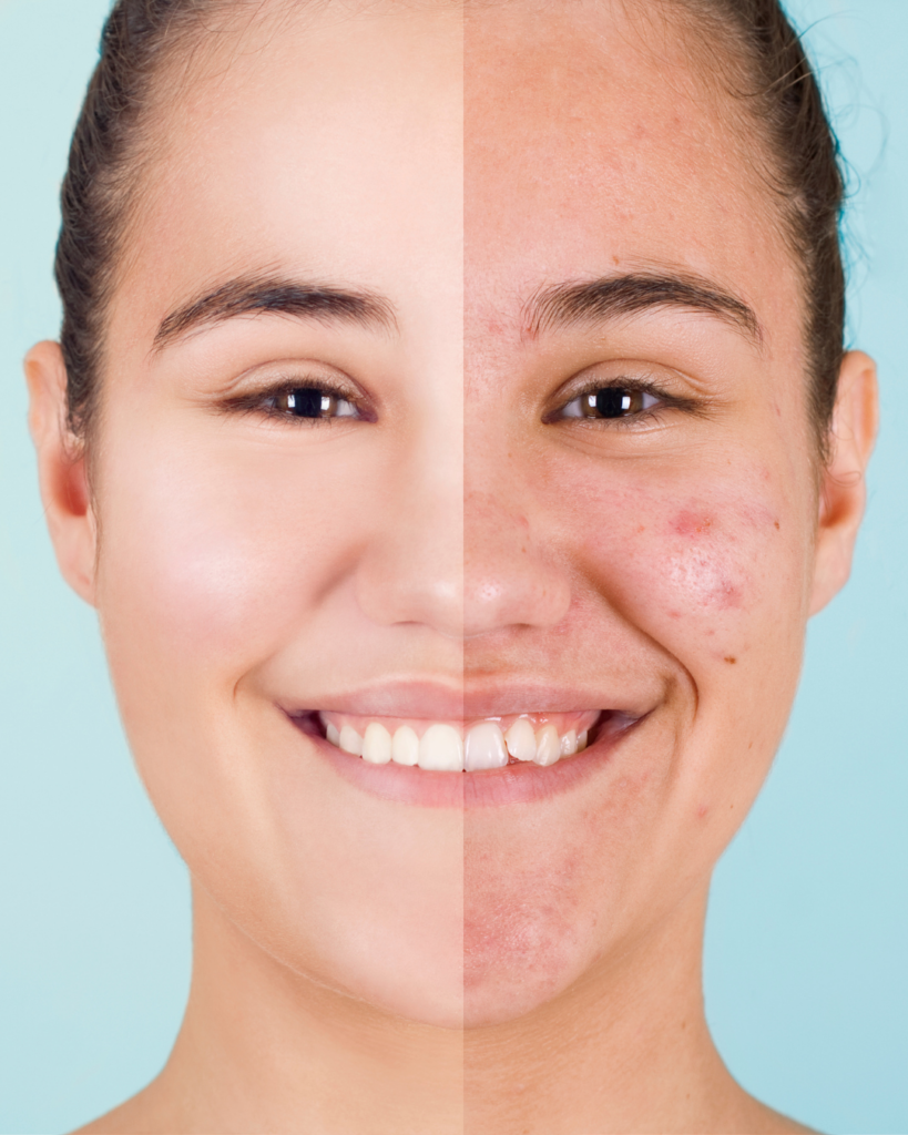 Before and after of a young lady using Seaweed for her magnesium deficiency.