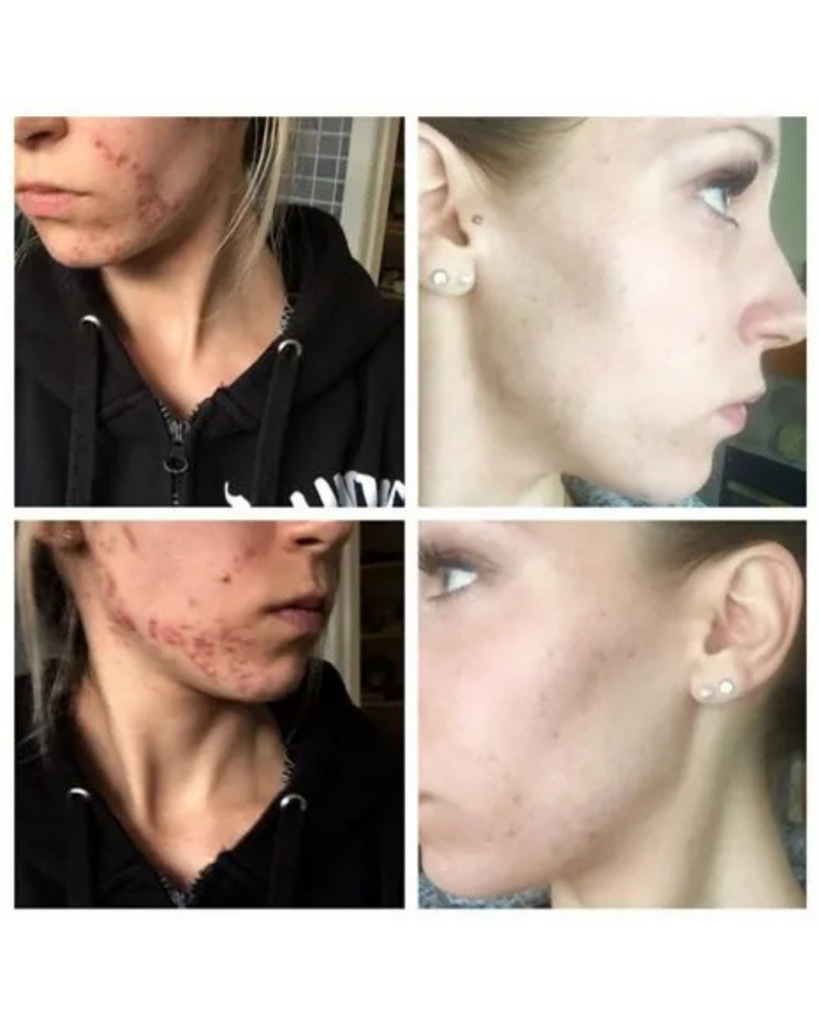 Four-panel before and after comparison showing the healing of jawline acne and redness using Seaflora skincare.
